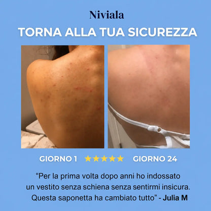 Bacne - acne della schiena