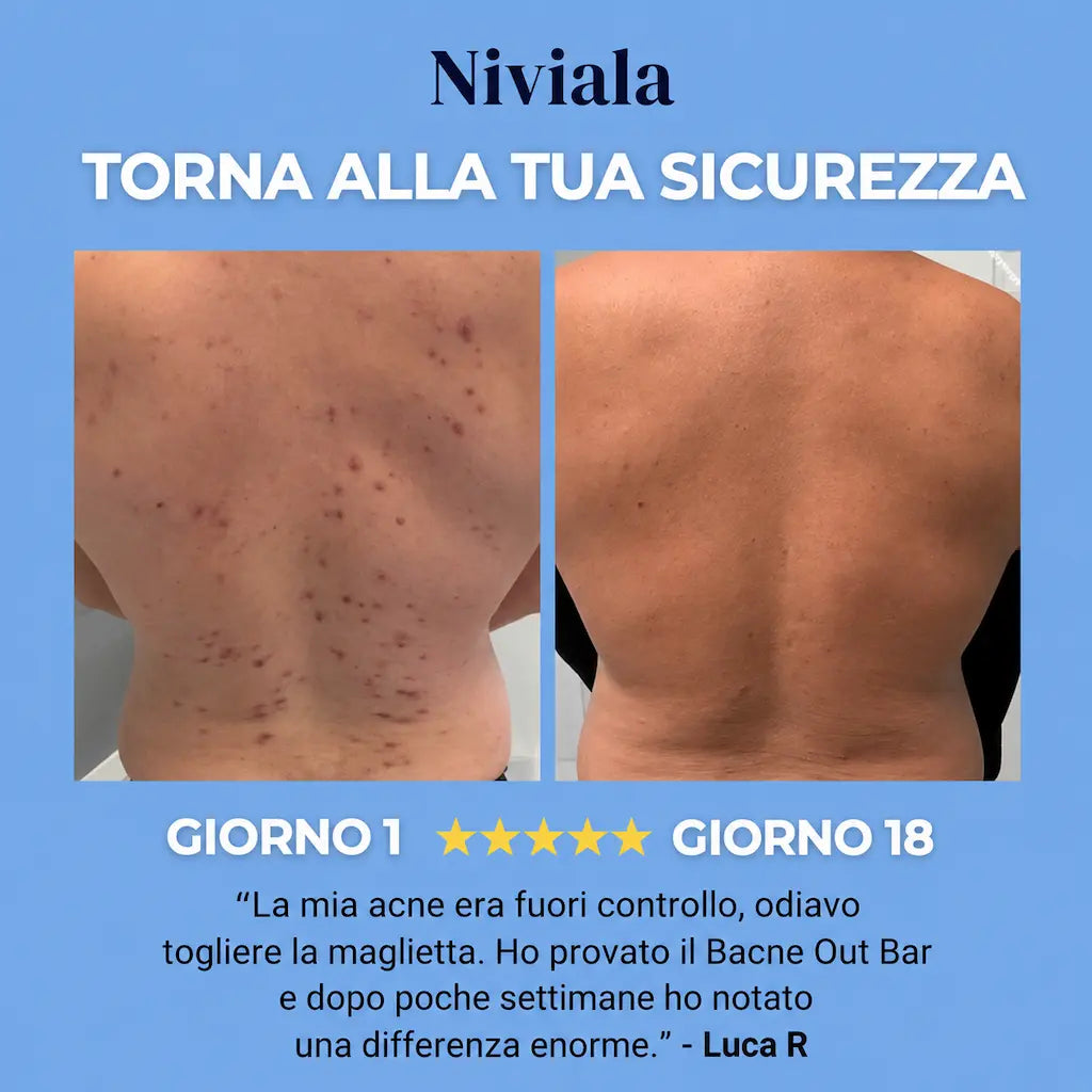 Bacne - acne della schiena