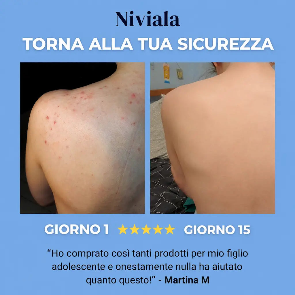 Bacne - acne della schiena